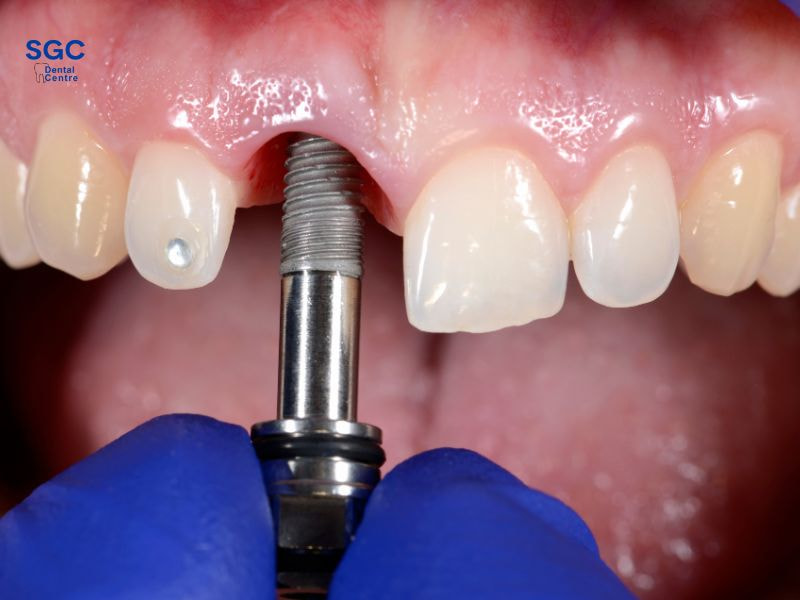 Trồng răng Implant khi vết thương nhổ răng đã ổn định