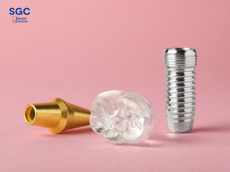 Chi phí trồng răng Implant phụ thuộc vào loại răng lựa chọn