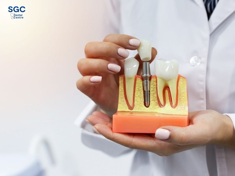 Giá trồng răng Implant phụ thuộc từng loại răng