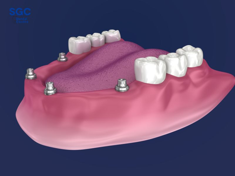 Kỹ thuật All On 4 là phương pháp sử dụng 4 trụ Implant cho toàn hàm