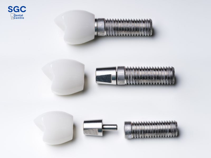 Lựa chọn loại răng tốt khi cấy Implant răng cửa