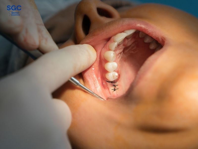 Nên trồng Implant sau khi vết thương nhổ răng đã ổn định