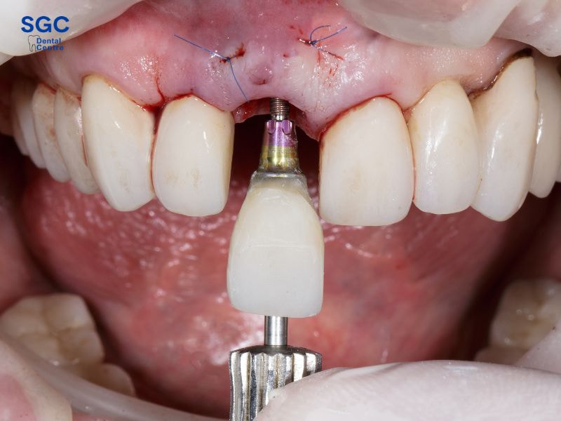 Cấy ghép Implant răng cửa giúp phục hình y như răng thật