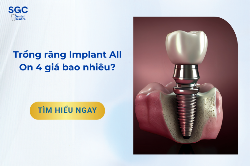 Trồng răng Implant All On 4 giá bao nhiêu?