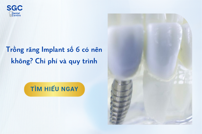 Trồng răng Implant số 6