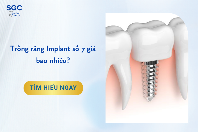 Trồng răng Implant số 7 giá bao nhiêu