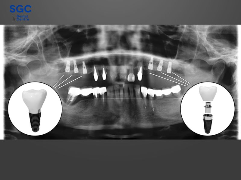Phương pháp All On 6 là kỹ thuật sử dụng 6 trụ Implant cấy ghép cho toàn hàm