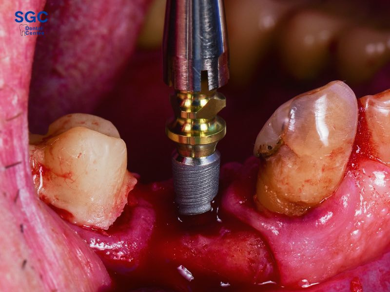 Trồng răng Implant có bảo hành không? Điều kiện áp dụng 1 Bảo hành răng Implant trong các trường hợp lỗi do phía nha khoa