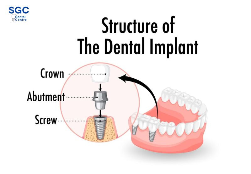 Trồng răng Implant đi máy bay hoàn toàn bình thường