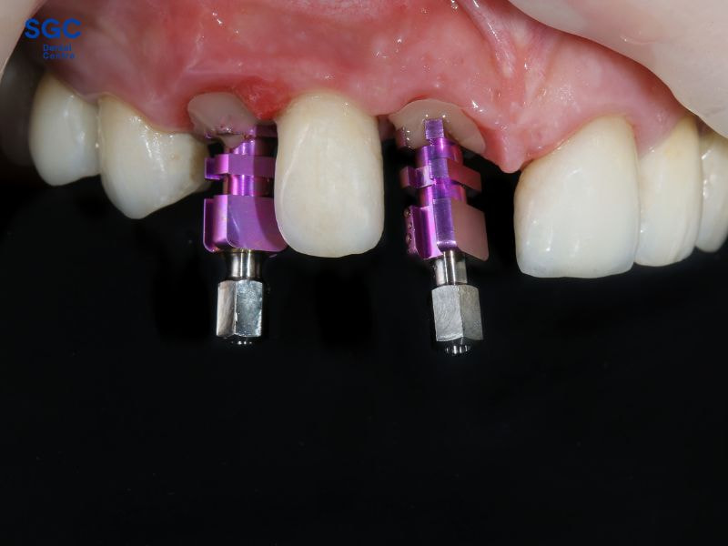 Cấy ghép Implant không rạch bảo tồn xương hàm