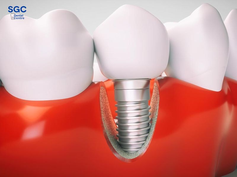 Chú ý sức khỏe răng miệng trước và sau khi cấy ghép Implant