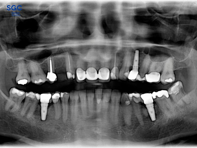 Chụp phim CT giúp bác sĩ xác định chính xác vị trí cắm trụ tốt nhất