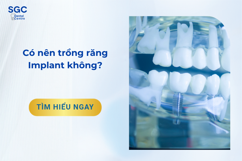 Có nên trồng răng Implant không?