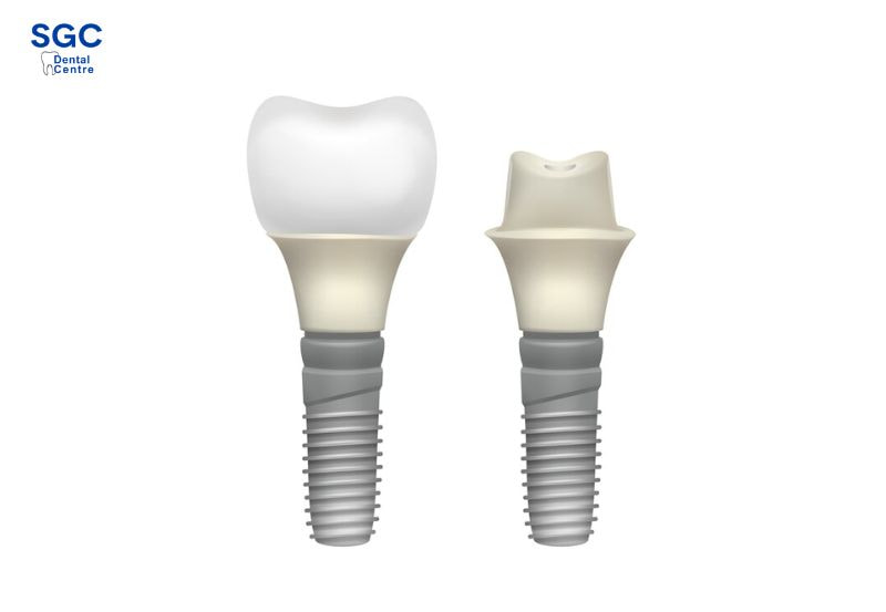 Trồng răng Implant không quá đau như bạn vẫn tưởng