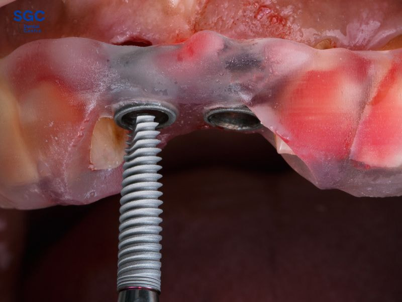 Công nghệ 4S là kỹ thuật cắm trụ Implant trực tiếp vào xương hàm không cần rạch lợi