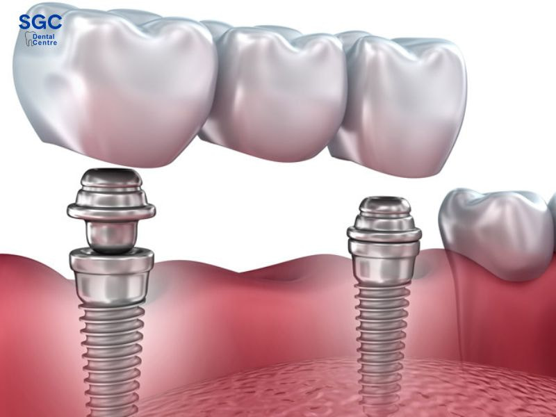 Làm cầu răng sứ trên Implant giúp tối ưu chi phí