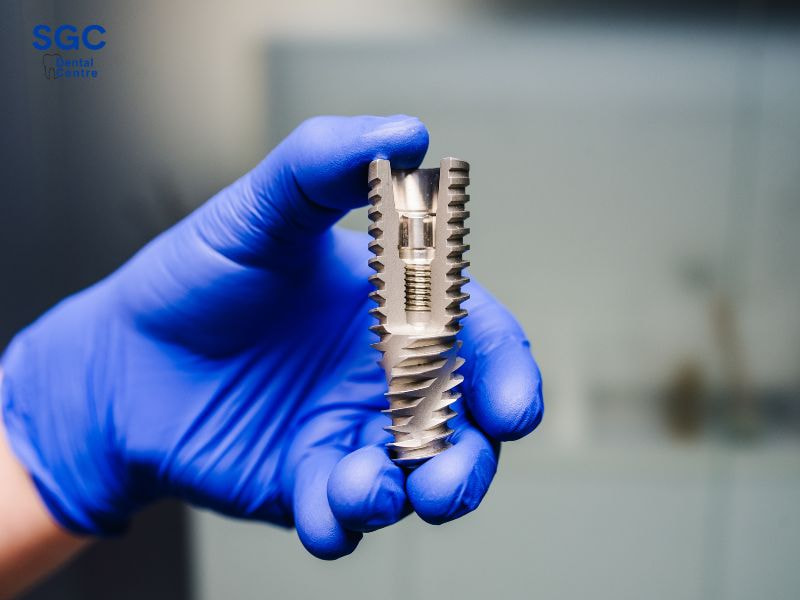 Lựa chọn loại răng Implant có giá phù hợp với khả năng