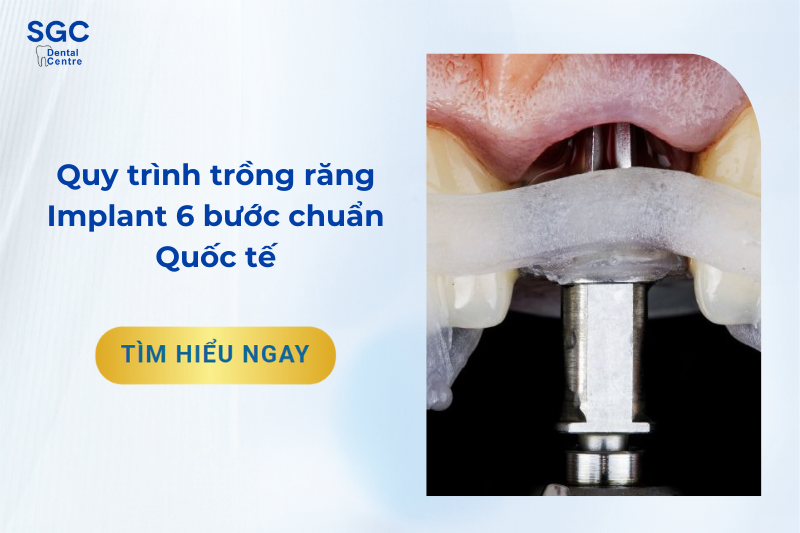 Quy trình trồng răng Implant