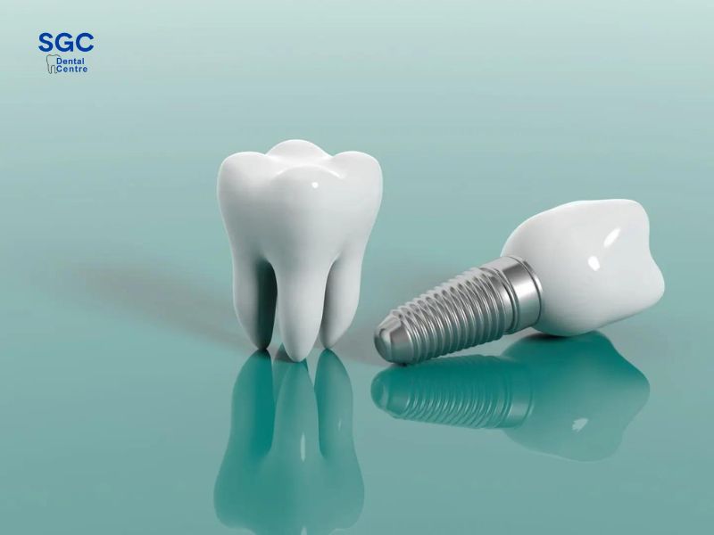 Răng Implant Hàn Quốc có nhiều loại với giá tốt