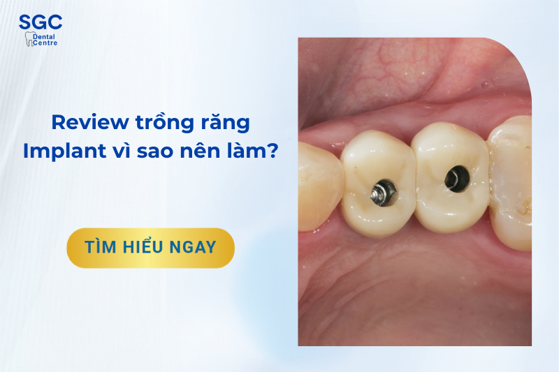 Review trồng răng Implant