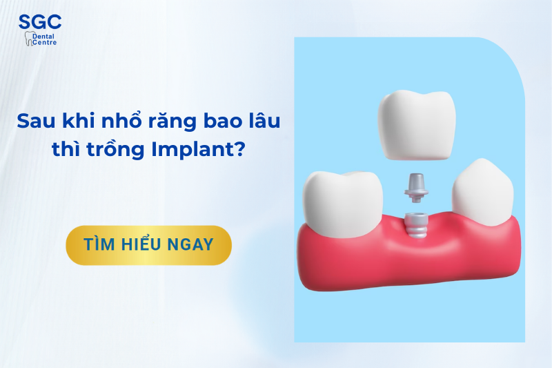 Sau khi nhổ răng bao lâu thì trồng Implant có hiệu quả?