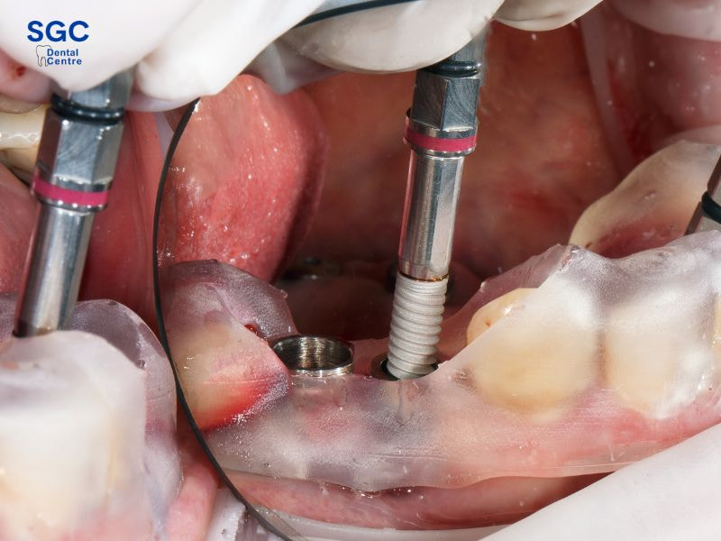 Trồng răng Implant có bảo hành không? Điều kiện áp dụng 2 Thời gian bảo hành tùy thuộc từng loại răng Implant