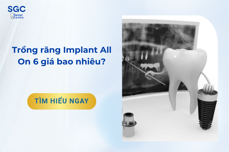 Trồng răng Implant All On 6 giá bao nhiêu?