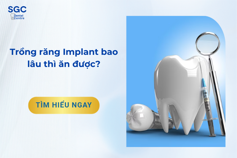 Trồng răng Implant bao lâu thì ăn được?