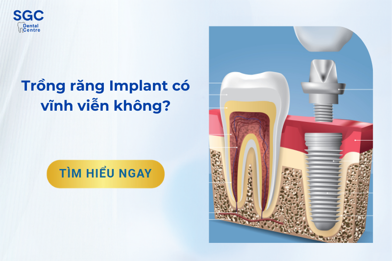 Trồng răng Implant có vĩnh viễn không?