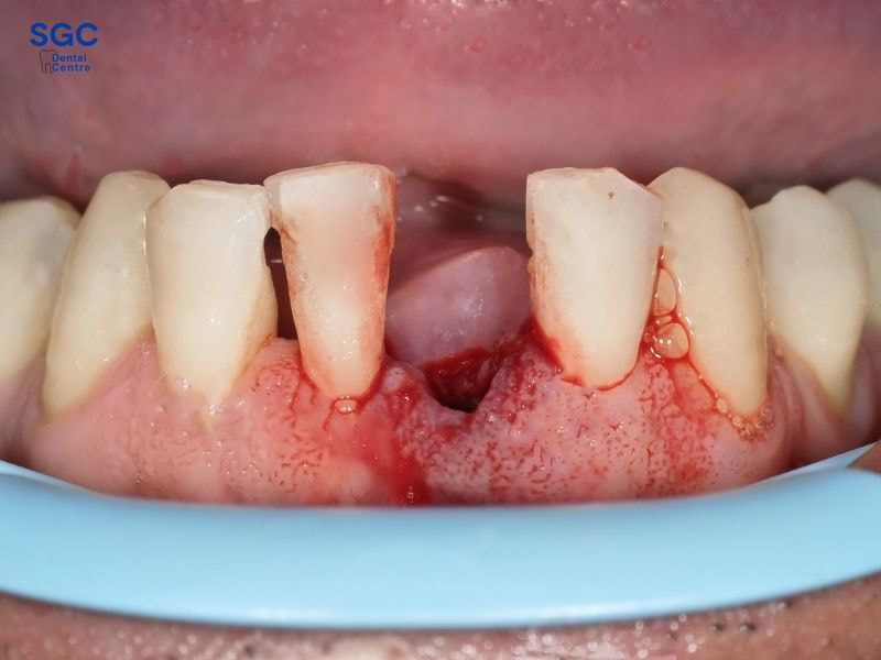 Trồng răng Implant giúp khôi phục thẩm mỹ khi bị mất răng