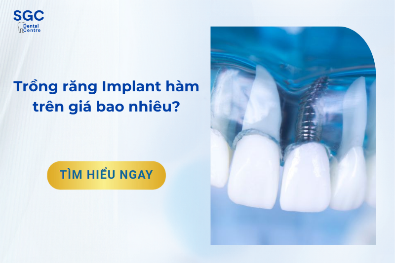 Trồng răng Implant hàm trên