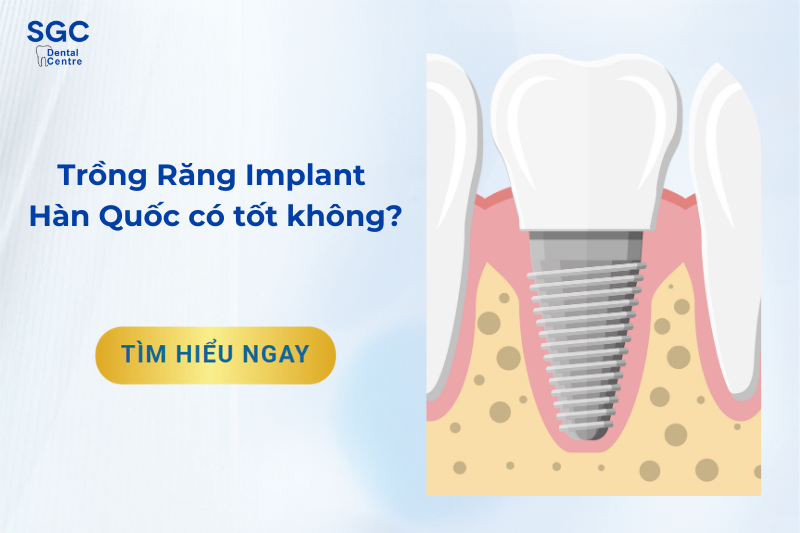 Trồng răng Implant Hàn Quốc có tốt không?