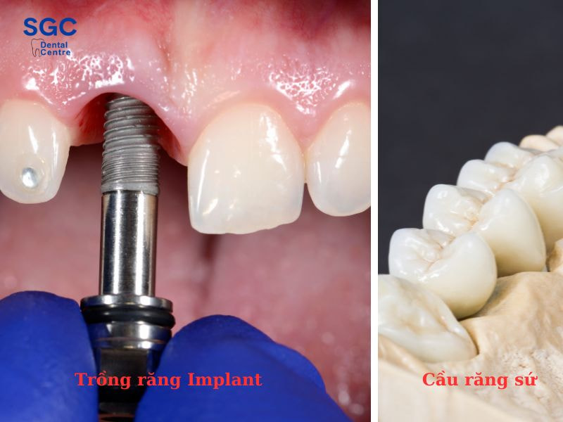 Trồng răng Implant hay cầu răng sứ đều có những ưu điểm riêng