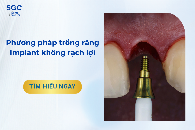 Trồng răng Implant không rạch lợi