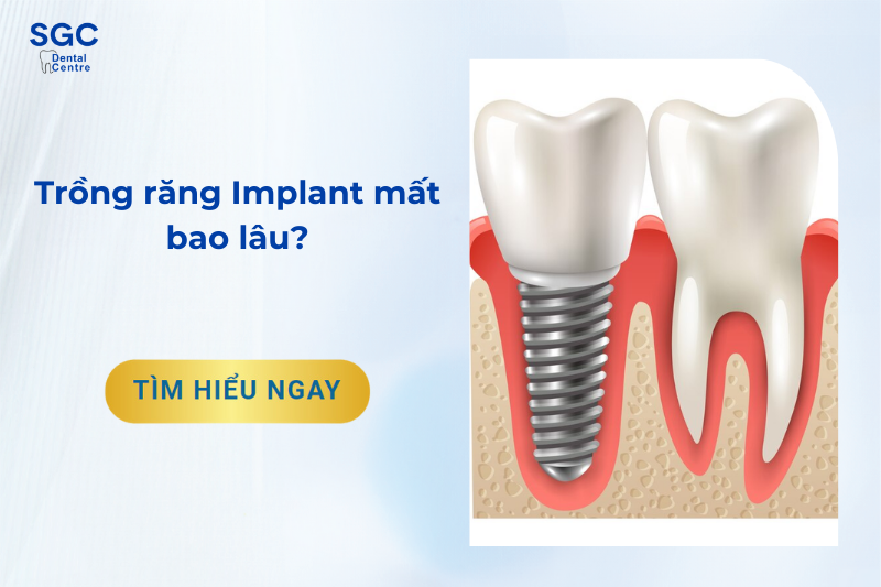 Trồng răng implant mất bao lâu?