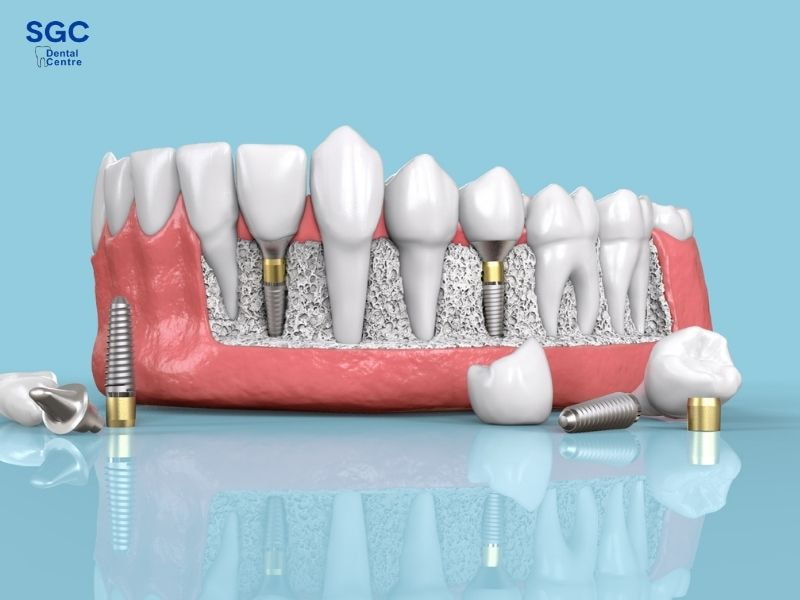 Trồng răng Implant Mỹ tại SGC yên tâm chất lượng