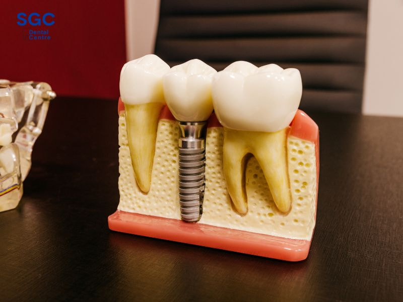 cấy ghép răng Implant nên chọn loại có chất lượng tốt