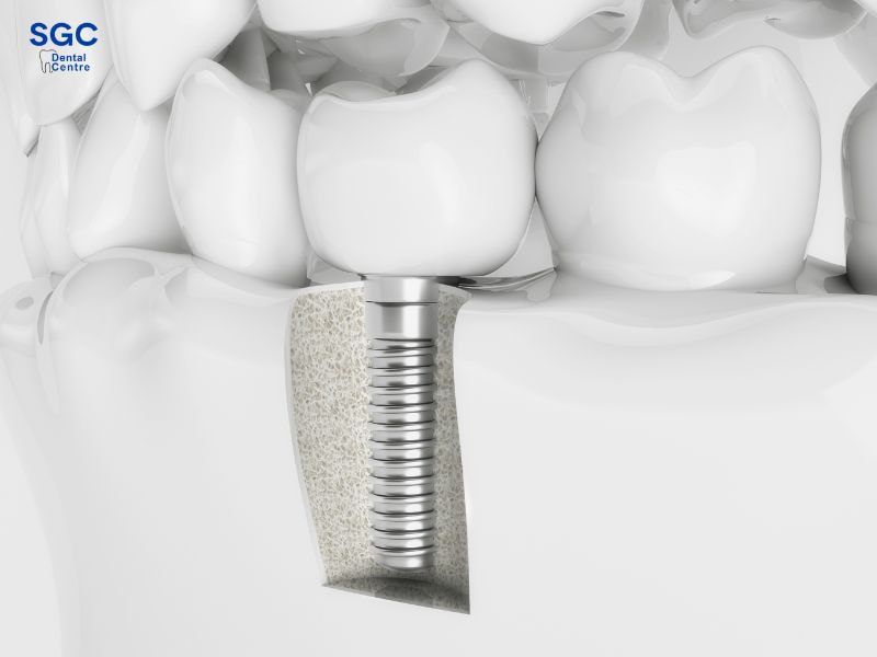 Trồng răng Implant nên chọn vật liệu chất lượng cao