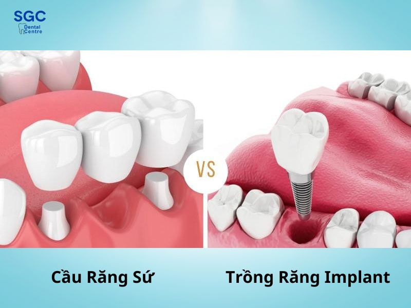 Trồng răng Implant và cầu răng sứ có cấu tạo khác nhau