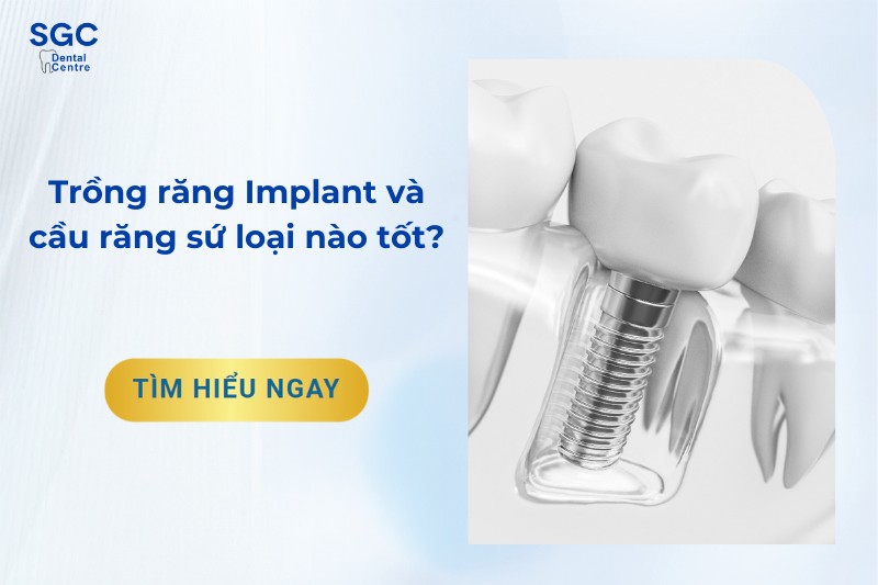 Trồng răng Implant và cầu răng sứ loại nào tốt?