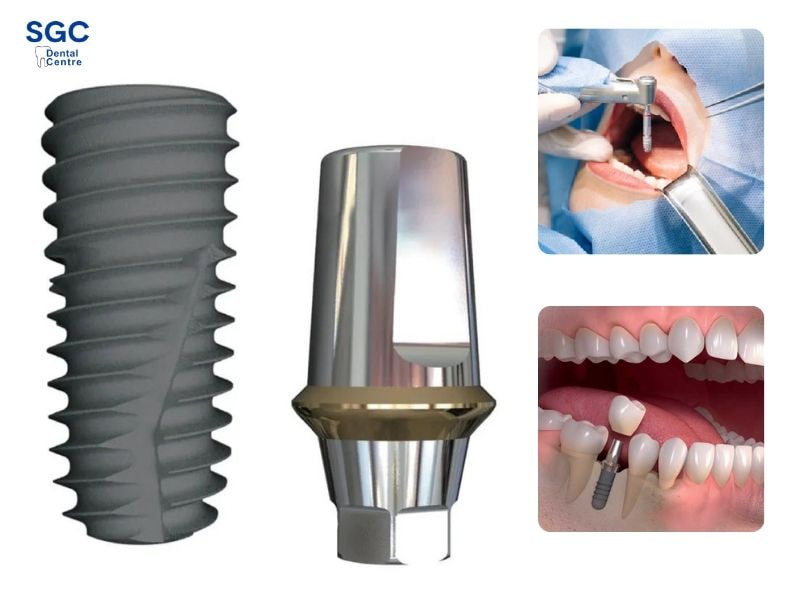 Trụ Hiossen thiết kế tối ưu cho mọi vị trí xương hàm