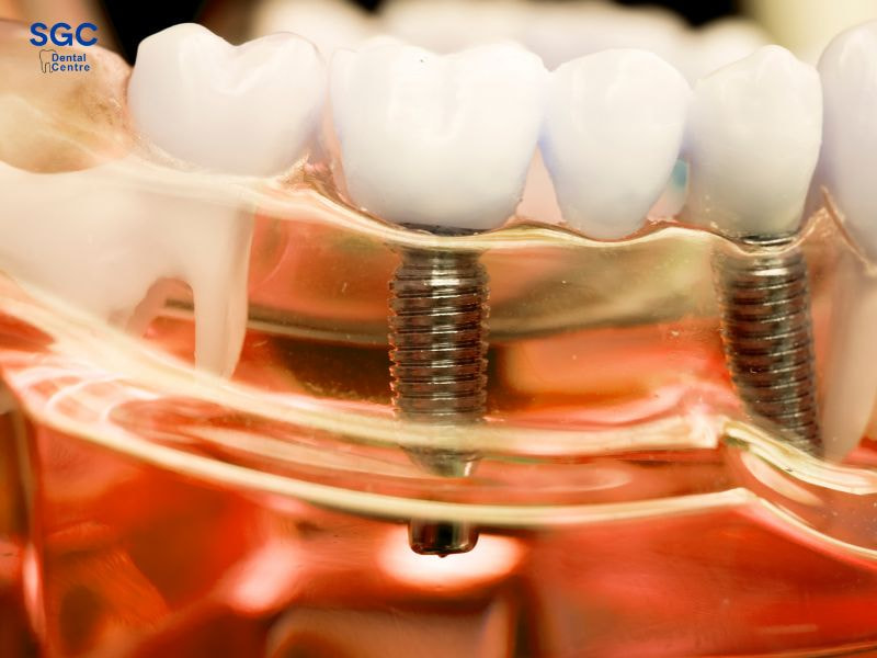 Trụ Implant được cố định chắc chắn vào xương hàm