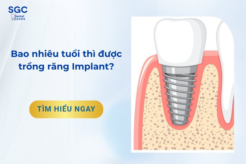 Bao nhiêu tuổi thì được trồng răng Implant?