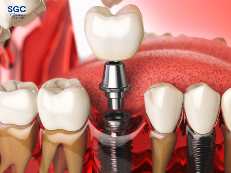 Implant có thể tháo được sau khi cấy ghép