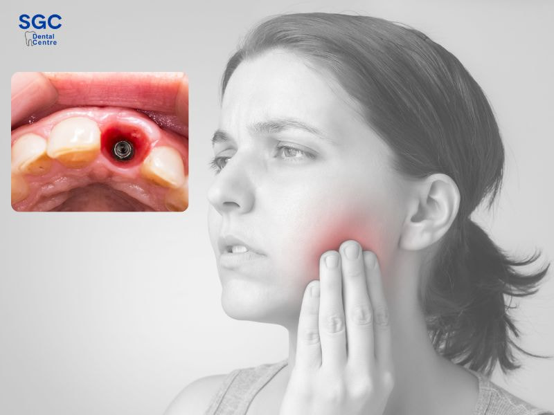 Đau nhức kéo dài sau khi trồng răng Implant là một biến chứng nguy hiểm
