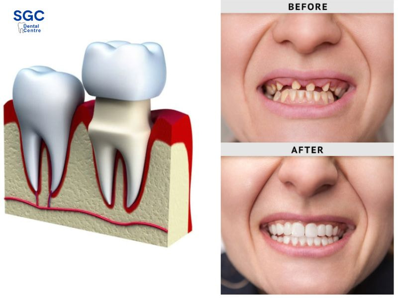 Kỹ thuật bọc sứ là phương pháp phục hình răng hiệu quả
