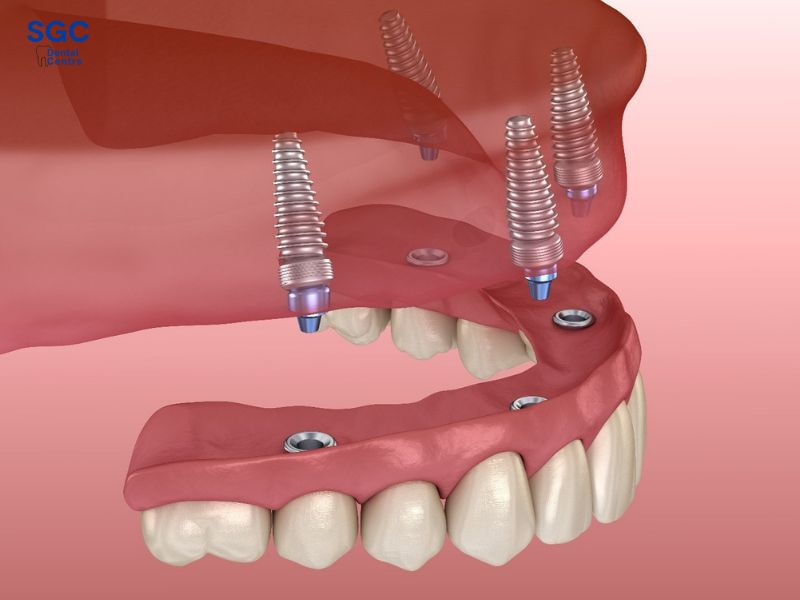 Làm hàm giả tháo lắp trên 4 trụ Implant