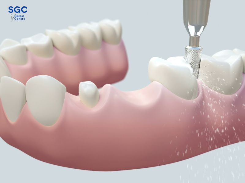 Mài răng quá sâu có thể gây ảnh hưởng răng thật