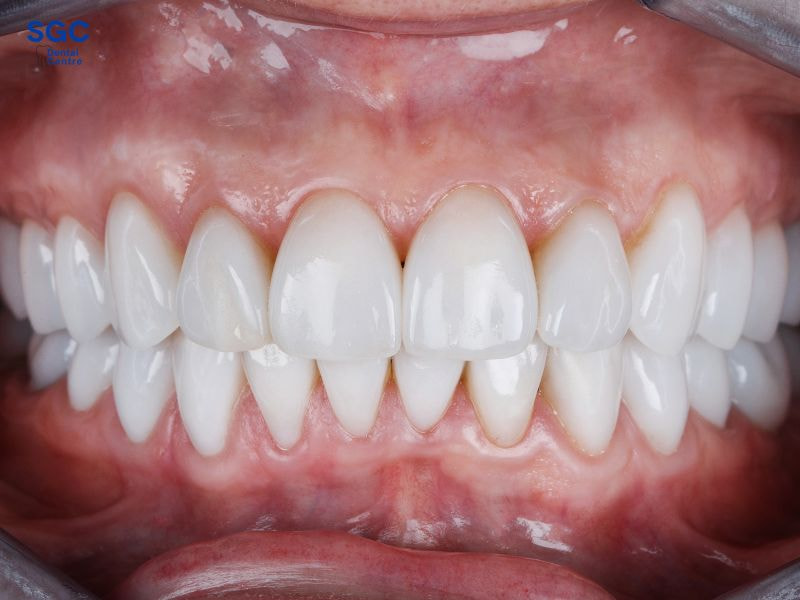 Nha Khoa SGC bọc răng sứ cao cấp, cam kết chất lượng