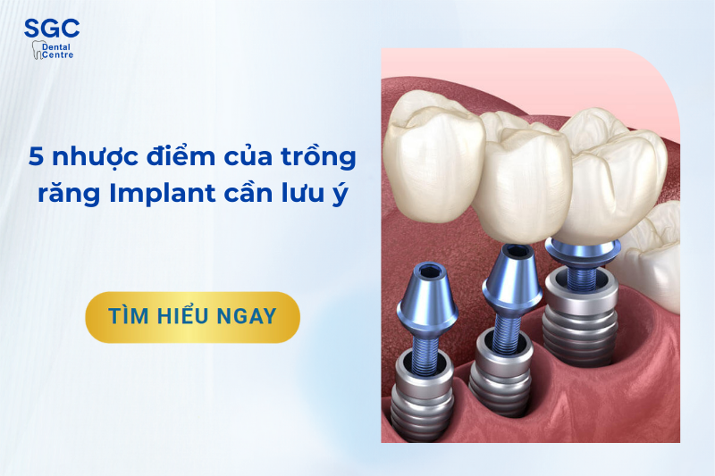 5 nhược điểm của trồng răng Implant nhất định phải biết